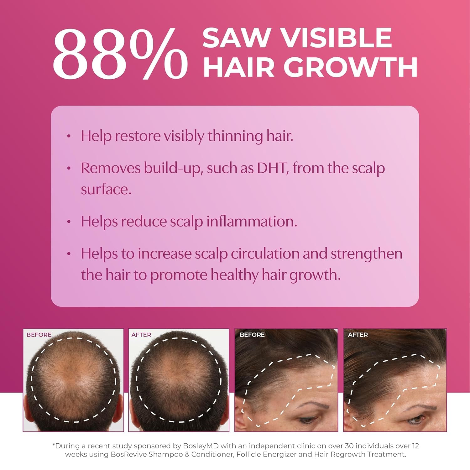 Women's Extra Strength Minoxidil 5% Topical (Foam) 2 Month Supply